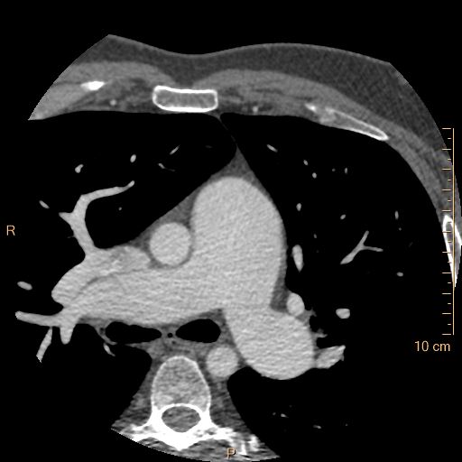 Atrial septal defect (upper sinus venosus type) with partial anomalous pulmonary venous return into superior vena cava (Radiopaedia 73228-83961 A 56).jpg