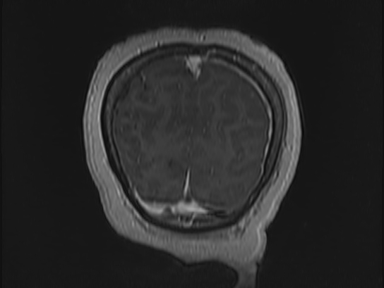 Atypical meningioma (Radiopaedia 62985-71406 Coronal T1 C+ 116).jpg