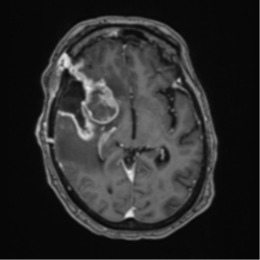 Atypical meningioma (WHO Grade II) (Radiopaedia 54742-60981 Axial T1 C+ 32).png