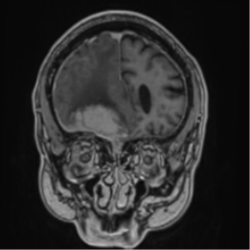 Atypical meningioma (WHO grade II) with brain invasion (Radiopaedia 57767-64729 Coronal T1 C+ 18).png