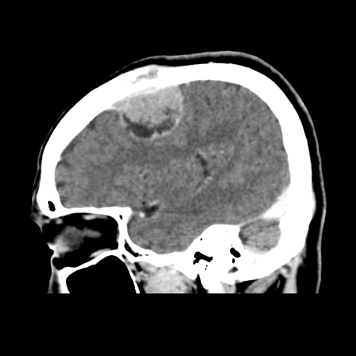 Atypical meningioma (WHO grade II) with osseous invasion (Radiopaedia 53654-59715 G 15).png
