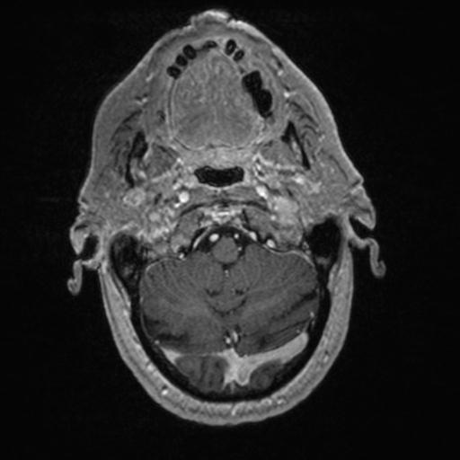 Atypical meningioma (grade II) - en plaque (Radiopaedia 29633-30147 Axial T1 C+ 32).jpg