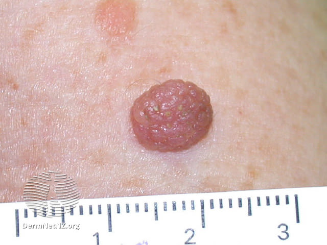 File:Atypical naevus (DermNet NZ lesions-atypical-naevi-589).jpg