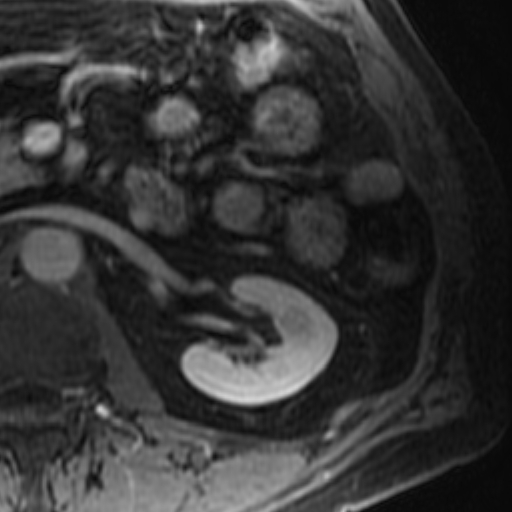 File:Atypical renal cyst on MRI (Radiopaedia 17349-17046 D 18).jpg