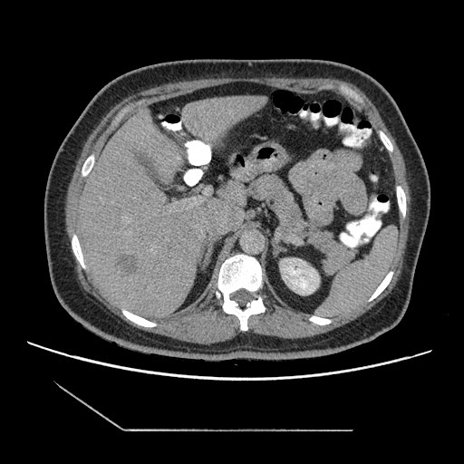 File:Atypical retroperitoneal lymphocoeles with large leiomyoma of uterus (Radiopaedia 32084-33024 A 13).jpg