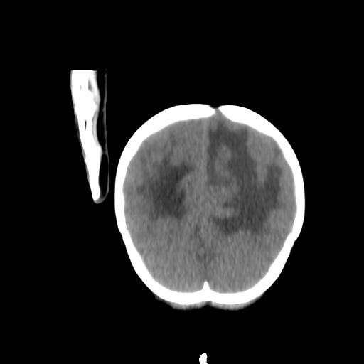 Atypical teratoid rhabdoid tumor (AT-RT) (Radiopaedia 85823-101654 Coronal non-contrast 47).jpg