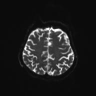 File:Autoimmune limbic encephalitis (Radiopaedia 30363-31005 Axial B0 and DWI 25).jpg