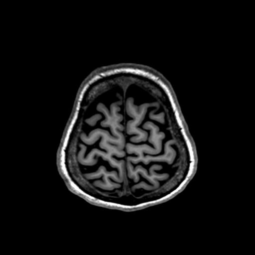 Autoimmune limbic encephalitis (Radiopaedia 30363-31005 T1 Axial 1mm 131).jpg
