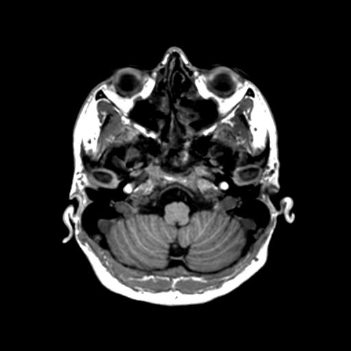 Autoimmune limbic encephalitis (Radiopaedia 30363-31005 T1 Axial 1mm 32).jpg