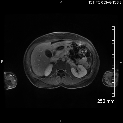 Autoimmune pancreatitis (Radiopaedia 88443-105101 A 68).jpg