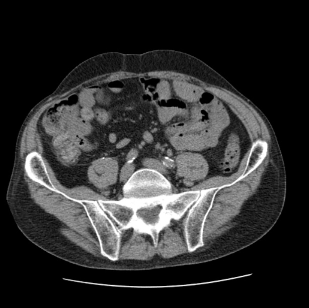 Autosomal dominant polycystic kidney disease (Radiopaedia 27851-28094 Axial non-contrast 91).jpg