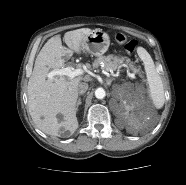 Autosomal dominant polycystic kidney disease (Radiopaedia 27851-28094 B 61).jpg