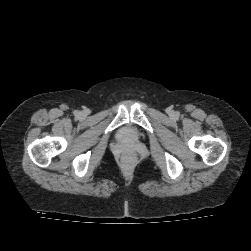 Autosomal dominant polycystic kidney disease (Radiopaedia 38189-40194 Axial C+ delayed 61).jpg