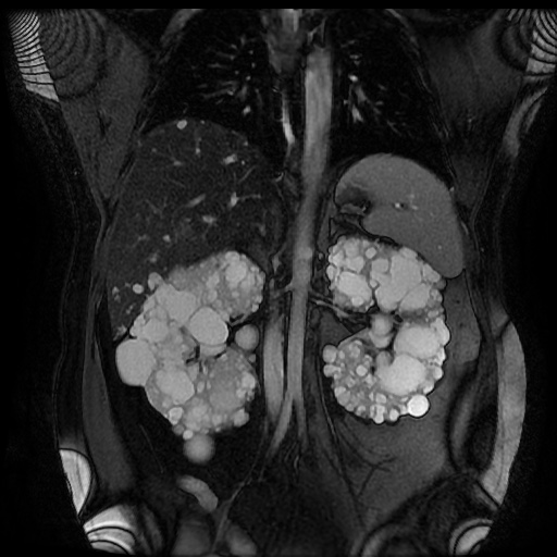 File:Autosomal dominant polycystic kidney disease (Radiopaedia 50259-55611 Coronal FIESTA 20).jpg