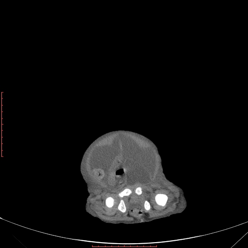Autosomal recessive polycystic kidney disease associated with Caroli disease (Radiopaedia 61932-69984 Axial non-contrast 343).jpg