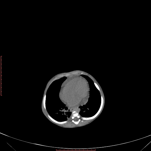 File:Autosomal recessive polycystic kidney disease associated with Caroli disease (Radiopaedia 61932-69984 Axial non-contrast 87).jpg