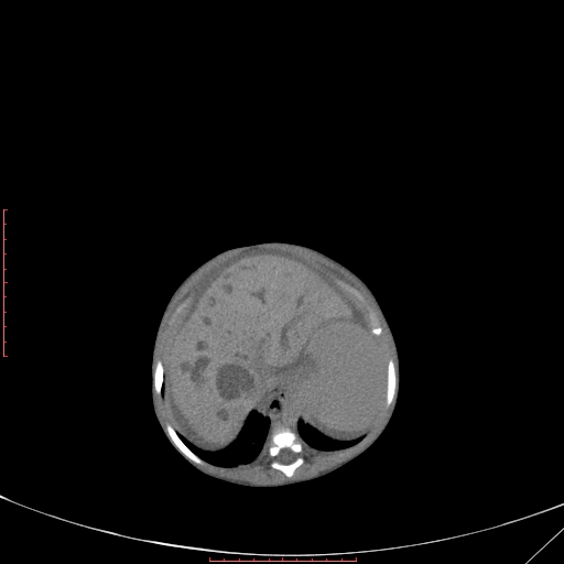 Autosomal recessive polycystic kidney disease associated with Caroli disease (Radiopaedia 61932-69984 B 113).jpg