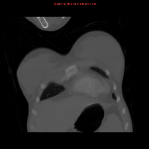 Avascular necrosis in sickle cell disease (Radiopaedia 17448-17152 Coronal bone window 17).jpg