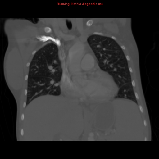 File:Avascular necrosis in sickle cell disease (Radiopaedia 17448-17152 Coronal bone window 55).jpg