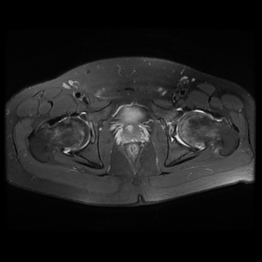 File:Avascular necrosis of the hip (Radiopaedia 61503-69465 Axial PD fat sat 19).jpg