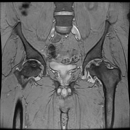 Avascular necrosis of the hip (Radiopaedia 61503-69465 F 42).jpg