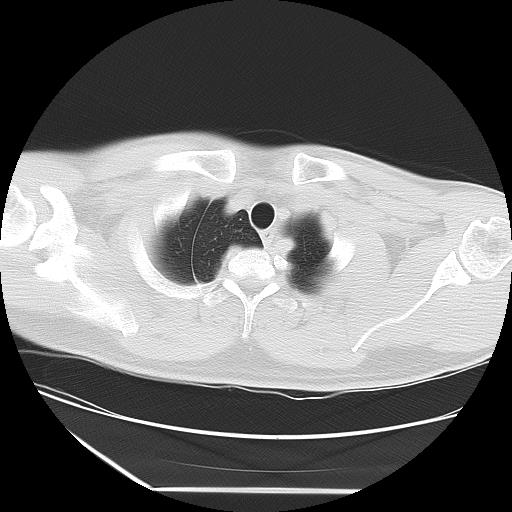 Azygos fissure (Radiopaedia 88181-104784 Axial lung window 4).jpg