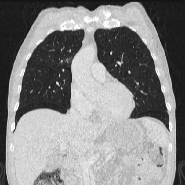 Azygos lobe (Radiopaedia 38259-40275 Coronal lung window 30).jpg