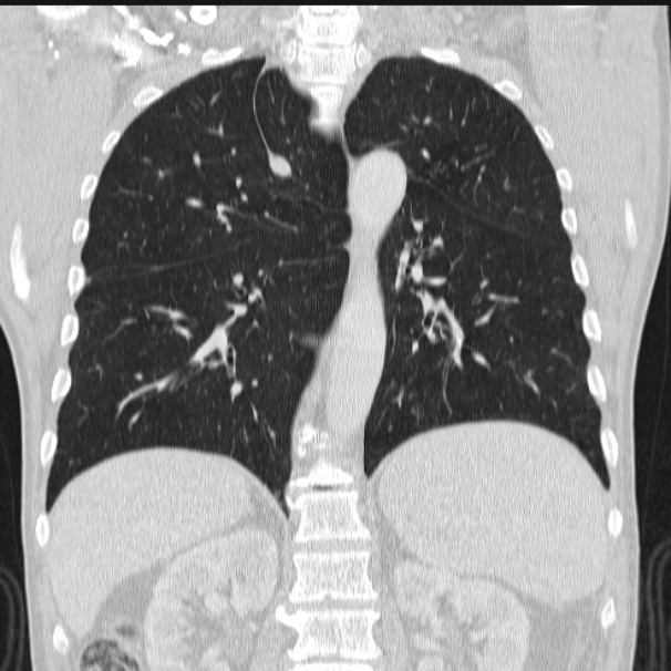 Azygos lobe (Radiopaedia 38259-40275 Coronal lung window 52).jpg