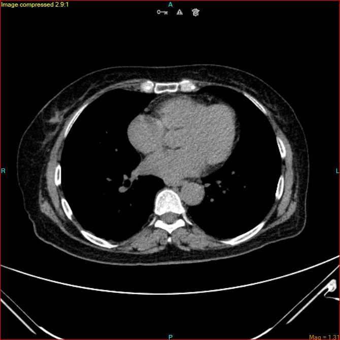 Azygos vein aneurysm (Radiopaedia 77824-90130 A 37).jpg