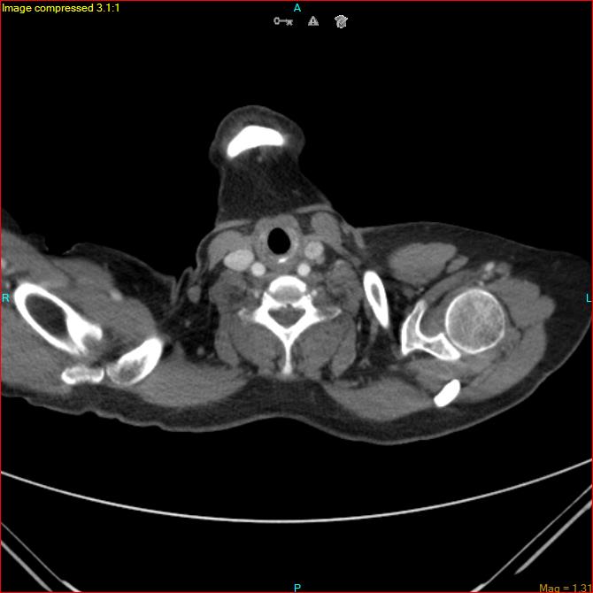 Azygos vein aneurysm (Radiopaedia 77824-90130 B 2).jpg