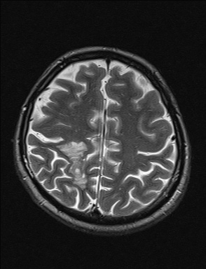File:Balo concentric sclerosis (Radiopaedia 50458-55940 Axial T2 11).jpg