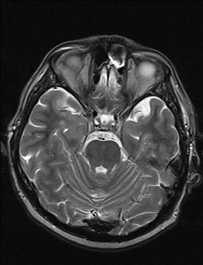 File:Balo concentric sclerosis (Radiopaedia 50458-55940 Axial T2 30).jpg
