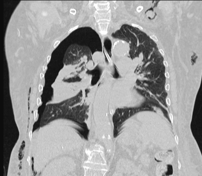 Barotrauma due to mechanical ventilation (Radiopaedia 28079-28336 Coronal lung window 58).jpg