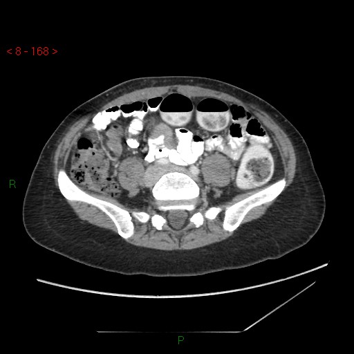 Bartholin gland cyst (Radiopaedia 54904-61181 A 42).jpg