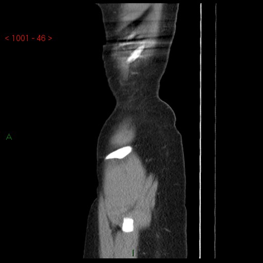 File:Bartholin gland cyst (Radiopaedia 54904-61181 Sagittal C+ delayed 46).jpg