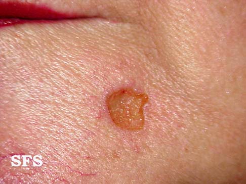 Basal Cell Carcinoma (Dermatology Atlas 15).jpg