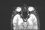 File:Basal cell carcinoma - nasal region (Radiopaedia 70292-80365 Axial DWI 2).jpg