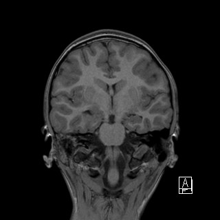 Base of skull rhabdomyosarcoma (Radiopaedia 32196-33142 Coronal T1 24).jpg