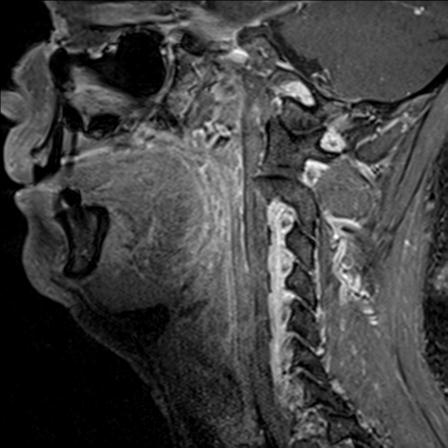 File:Base of tongue squamous cell carcinoma (Radiopaedia 31174-31884 F 110).jpg