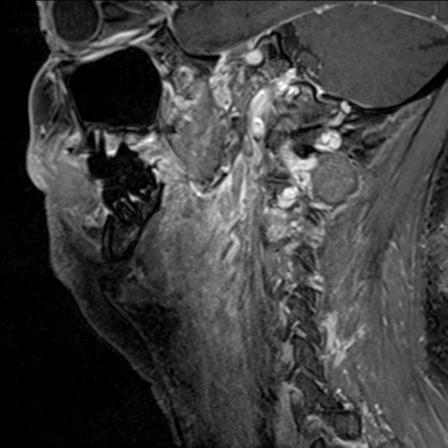Base of tongue squamous cell carcinoma (Radiopaedia 31174-31884 F 57).jpg