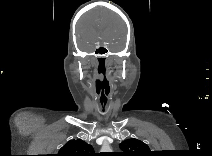 Basilar artery aneurysm (Radiopaedia 56261-62932 B 8).jpg