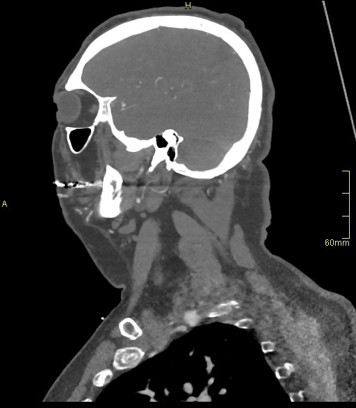 Basilar artery aneurysm (Radiopaedia 56261-62932 C 1).jpg