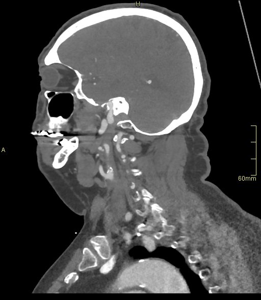 Basilar artery aneurysm (Radiopaedia 56261-62932 C 50).jpg