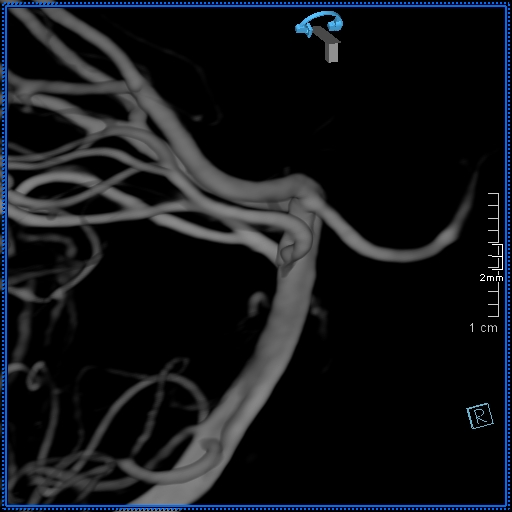 Basilar artery perforator aneurysm (Radiopaedia 82455-99524 3D Left VA 66).jpg