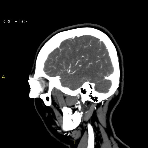 Basilar artery thrombosis (Radiopaedia 16260-15944 C 13).jpg