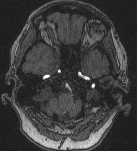 Basilar tip aneurysm (Radiopaedia 26504-26632 MRA 37).jpg
