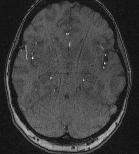 Basilar tip aneurysm (Radiopaedia 26504-26632 MRA 93).jpg