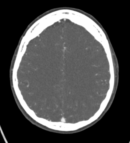 Basilar tip aneurysm with coiling (Radiopaedia 53912-60086 A 105).jpg