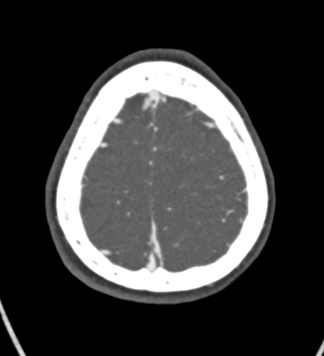 Basilar tip aneurysm with coiling (Radiopaedia 53912-60086 A 129).jpg
