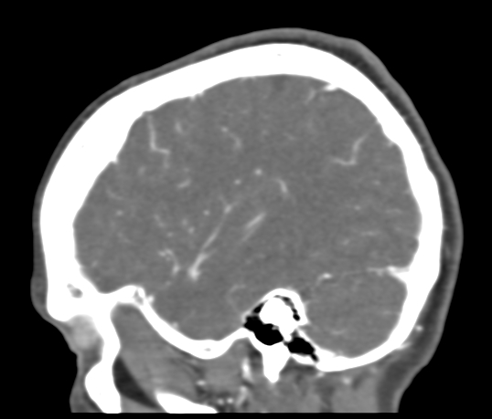 Basilar tip aneurysm with coiling (Radiopaedia 53912-60086 C 106).jpg